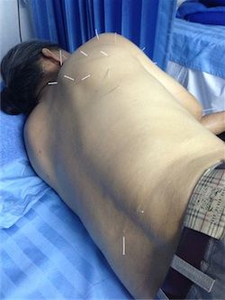 ฝังเข็มปวดหลัง 3 ปวดหลัง