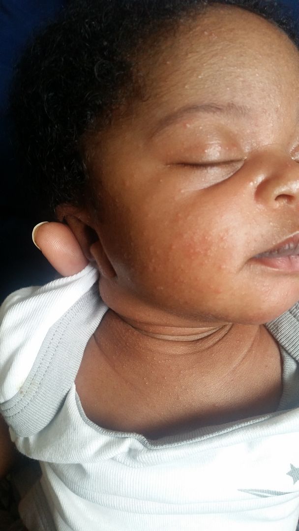 Rash on face and neck BabyCenter